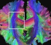 human brain scan using MRI/DTI